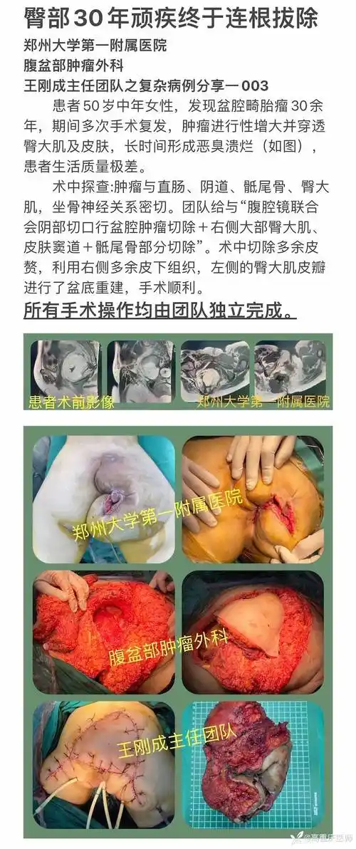 30年顽疾,一朝切除,利用臀大肌皮瓣,加快切口愈合