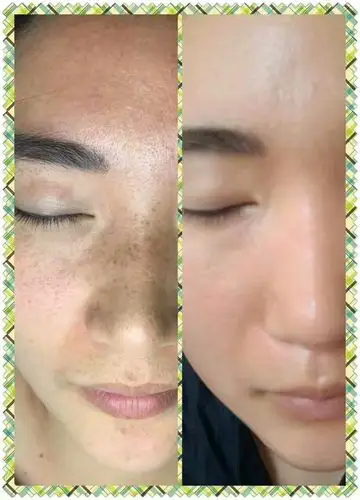 祛斑前后比较
