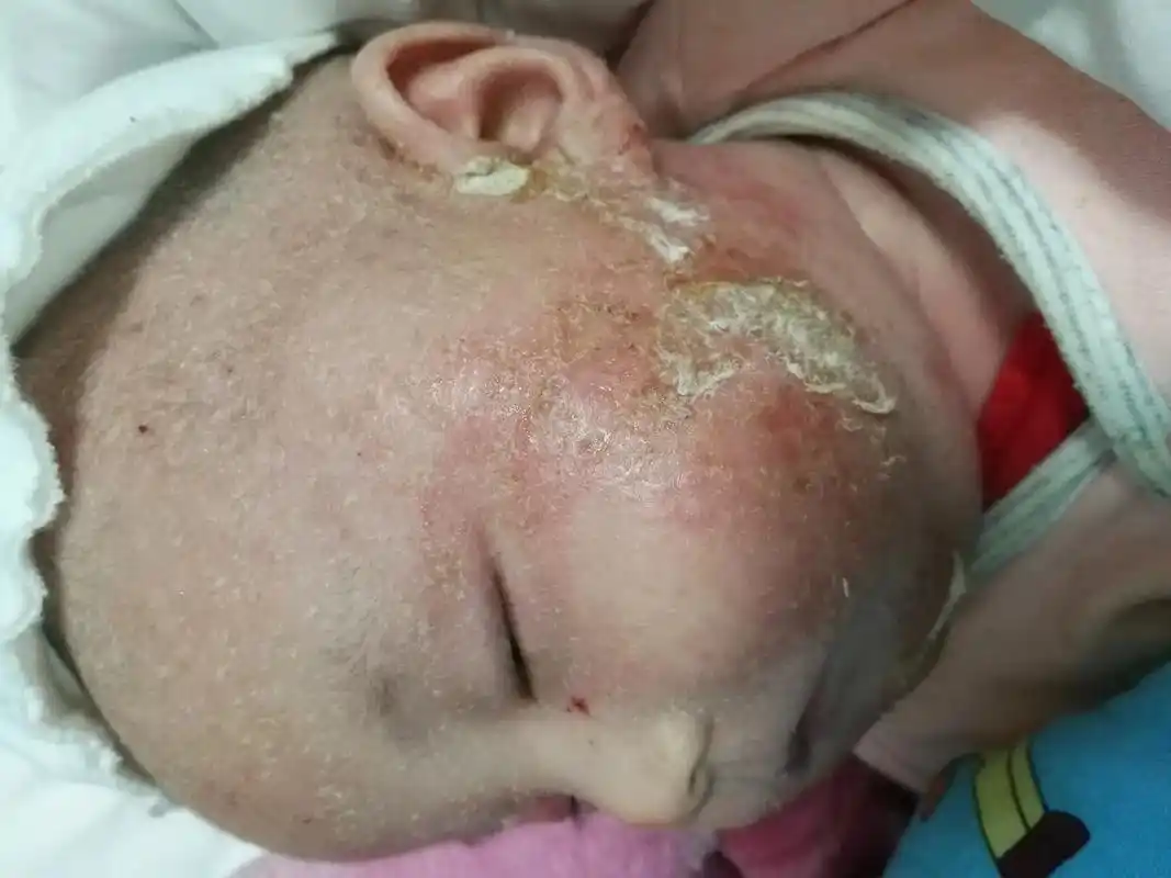 泼尼松,西替利嗪,地奈德乳膏,夫西地酸,磞酸,生理盐水,炉甘 - 抖音