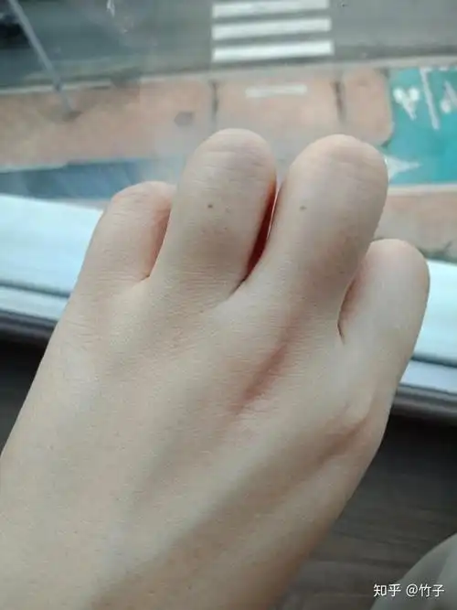 本人女左手无名指半年前多新长了一颗痣 有什么寓意?