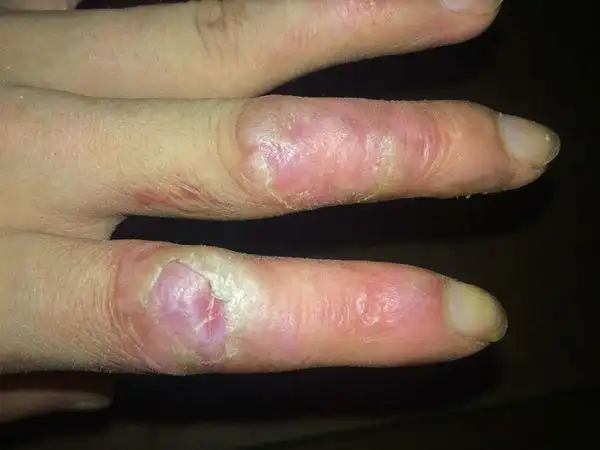 手指关节长硬疙瘩手指关节硬疙瘩