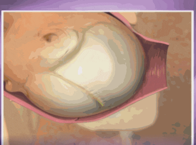 入盆症状|胎儿入盆的肚子形状 胎儿入盆是种什么体验?