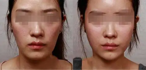 面部脂肪填充前后对比图