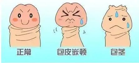 包皮嵌顿能复原吗