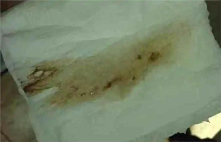 子宫颈炎或子宫颈内膜炎等引起的白带发黄的症状2白带发黄或黄绿色