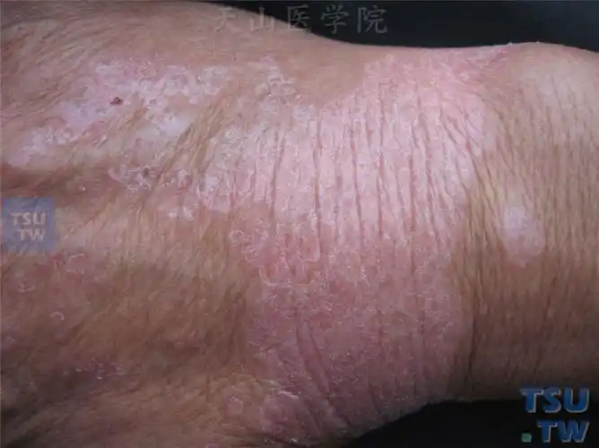 斑块型副银屑病(parapsoriasis en plaques)症状表现 - 皮肤病学