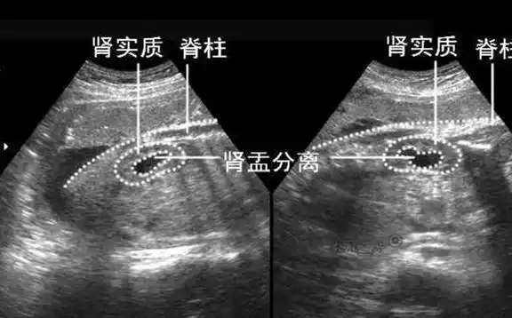 b超单上的"肾盂分离"是啥意思?和性别有关系吗?