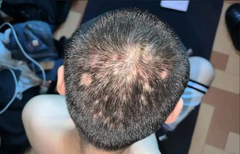 皮肤上有毛囊炎该怎么办-上海海华医院科普