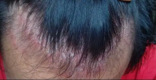 脂溢性头皮炎症如何治疗 用什么药物.具体药名是什么.谢谢