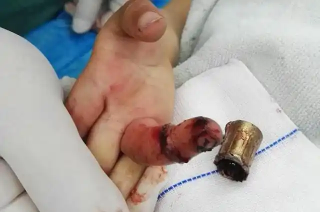 看着都疼!女童手指套金属环2天,手指发黑险截肢