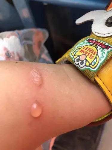 儿子一岁半身上老反复起水泡怎么回事