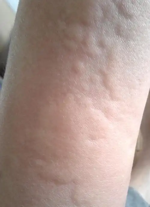 疑似海鲜过敏,求医生看病