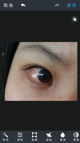 眼睛是泡性结膜炎吗?