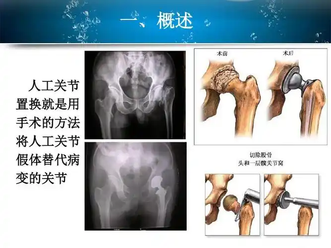 全髋关节置换术的教学查房综述.ppt