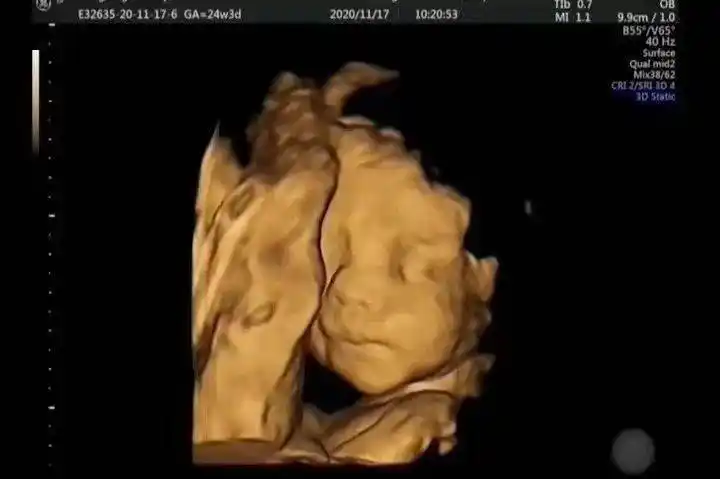 科普胎儿的第一张照片四维超声