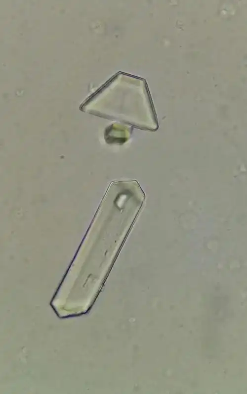 磷酸铵镁结晶#尿#体液检录