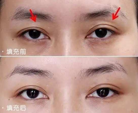 对于眼窝凹陷主要采用玻尿酸注射,自体脂肪填充来进行治疗.