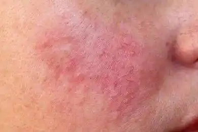 微课堂】常见的面部皮炎类型_手机搜狐网