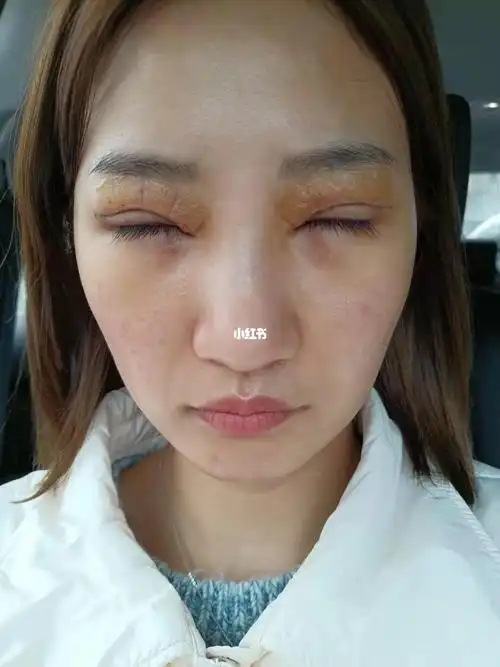 双眼皮修复术后第7天_双眼皮_美妆_医美整形