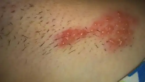 腋下起了小水泡是怎么回事?