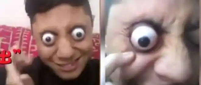 6岁男童模仿特效视频抠眼球 导致眼球淤血鼓出