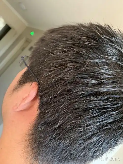 前几年头顶发现张了几根白头发,最近发现白头发特别多了,是什么原因