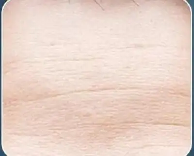 额头经常会出现暗沉,长痘,抬头纹明显,细小干纹多等皮肤问题,这就导致