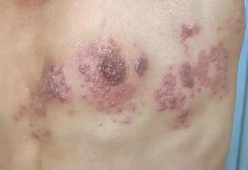 病毒性皮肤病之带状疱疹_带状疱疹_介绍_治疗方式 - 好大夫在线