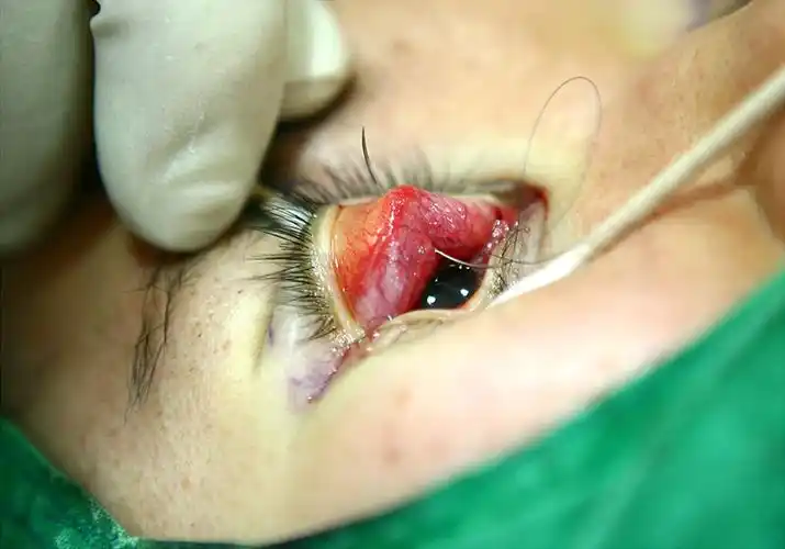 高清图真实案例解析埋线缝线双眼皮如何解决大小眼