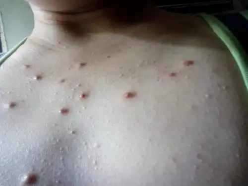 请问是什么皮肤病啊,挤又挤不出,烦死了