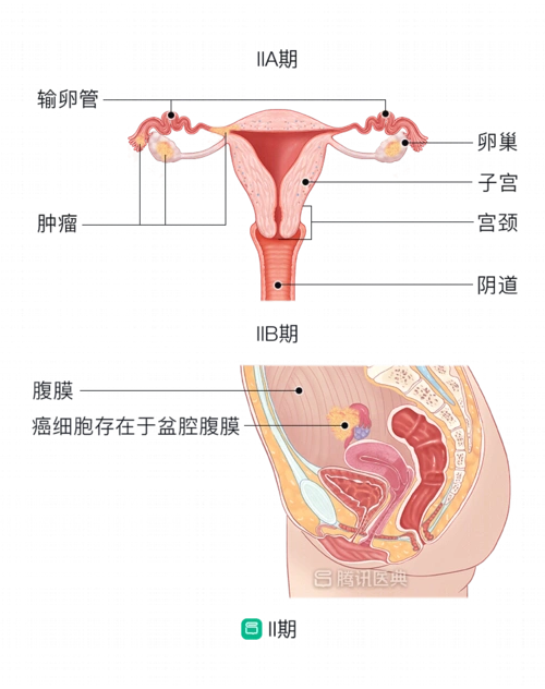 保护子宫很重要做好这4点才能把癌症赶跑