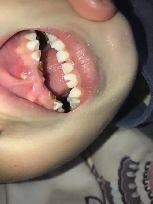 牙床上面长个牙,用不用拔掉,怎么办