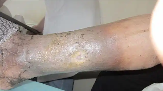 年过七旬老先生腿部发黑溃烂六年多,知道原因后不知