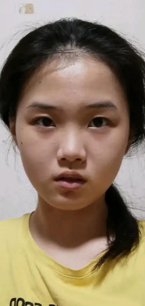 想看适不适合割双眼皮