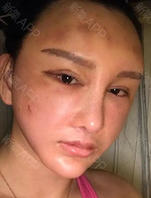 脂肪填充失败修复