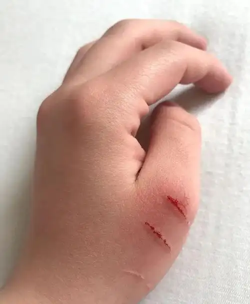 小伤口处理不好竟能夺命!伤口怎样处理最科学?