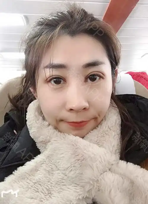 1月18号,我在青岛元美整形做的埋线双眼皮 开内眼_圈子-新氧美容整形
