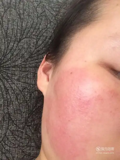 吃了芒果过敏该如何处理