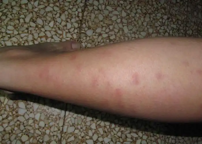 谁知道腿上张这个红斑是咋回事?谢谢!