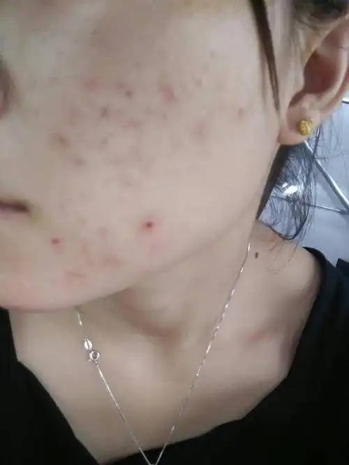 脸上冒出痘痘怎么办?教你一个"小妙招",轻松祛痘还你白净肌肤