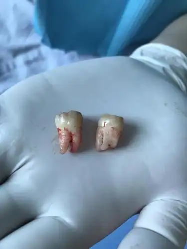 人生第一次拔智齿,有什么要问的