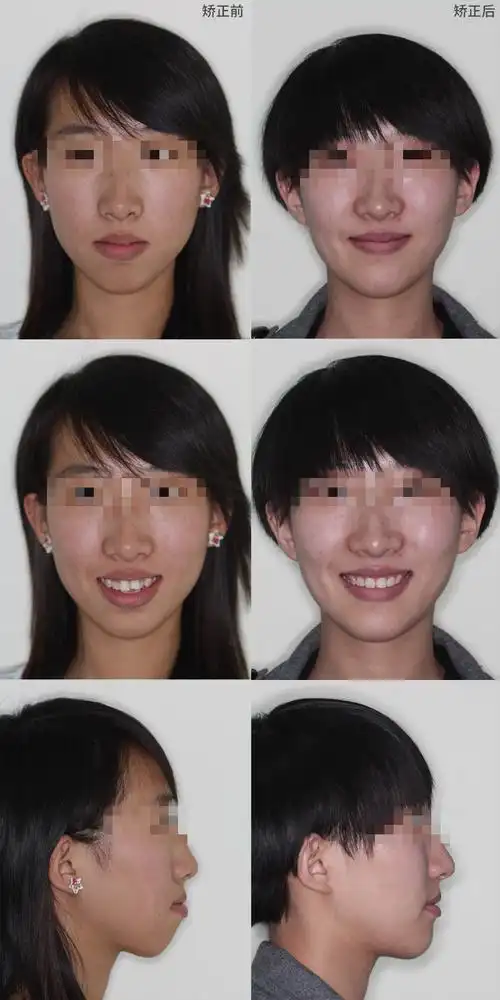 龅牙嘴凸没下巴,牙齿矫正对外貌的变化有多大?