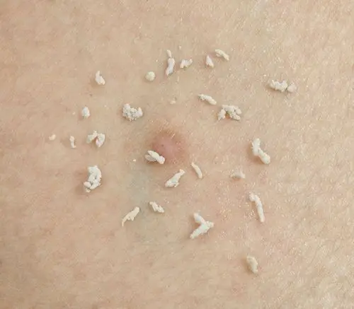 日本制代购女士专用去除淡化眼部颈部凸起脂肪粒角质粒油脂粒15g