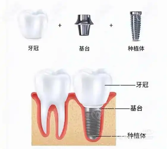 种植牙前,会先做一个口腔全景片.