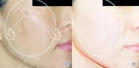 从而改善肤质,皮肤色泽,细小皱纹等问题,来达到美白的