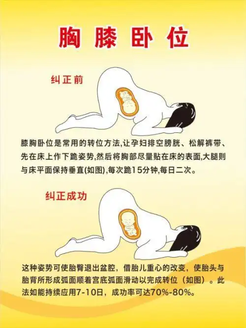 胎位不正就只能剖腹产?先试试这个胎位纠正办法吧