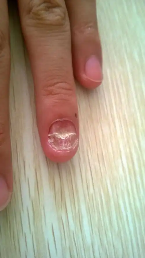 指甲手上 新生的支架 断层! 求解答? 超级不平整,吓人啊!