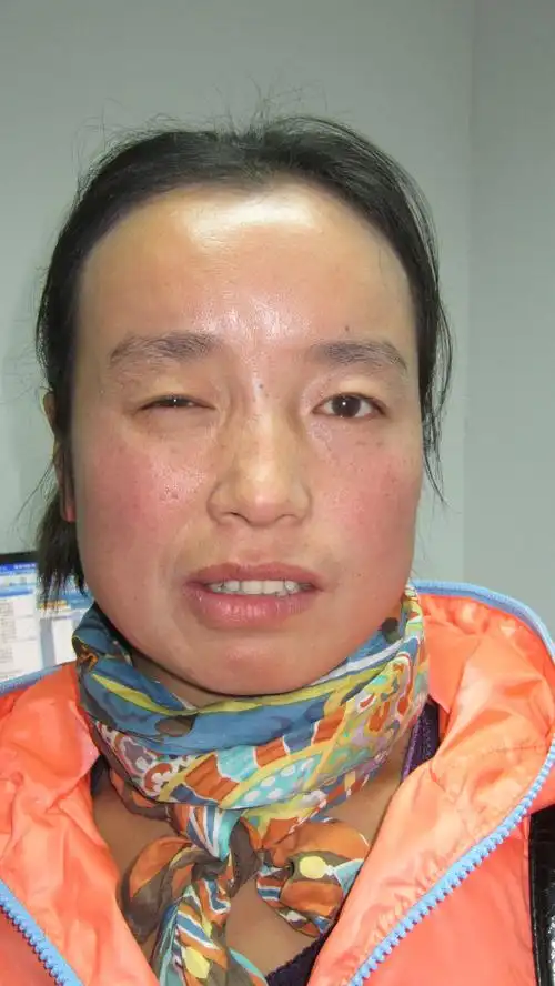 尤其是完全保留血管,神经功能的特性,成为目前面肌痉挛最有效的治疗