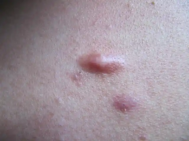 胸前皮肤长了个东西,痘(黄豆大小),但有医生说不是.