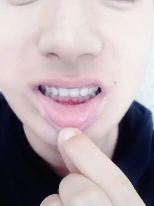 我牙齿看起来还算齐 就是上牙有点盖住下牙 导致下巴短 后缩 能矫正嘛